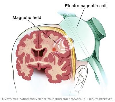 Transcranial Magnetic Stimulation How It Works