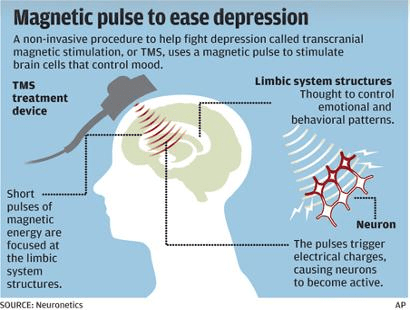 TMS - Transcranial Magnetic Stimulation Therapy - Williamsville Psychiatry